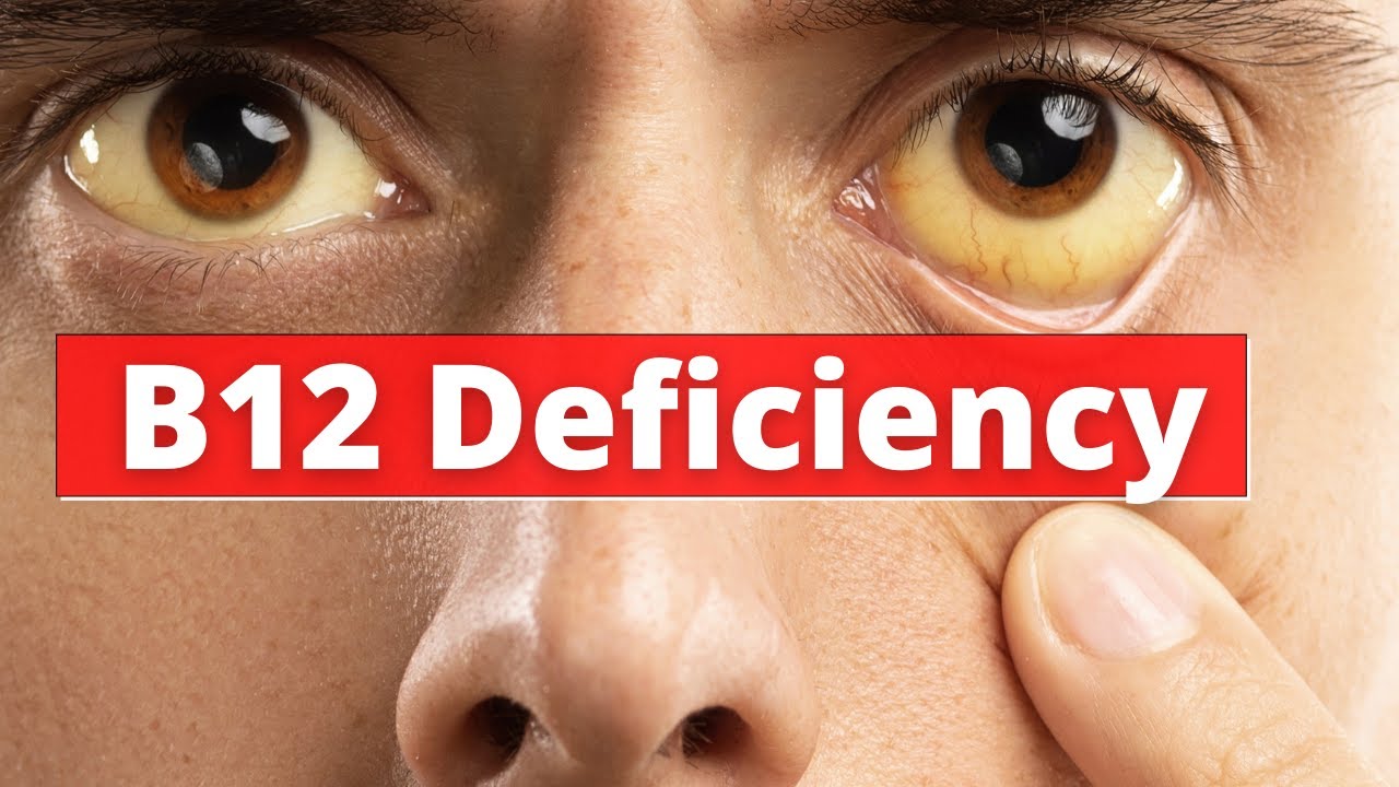 b12 deficiency